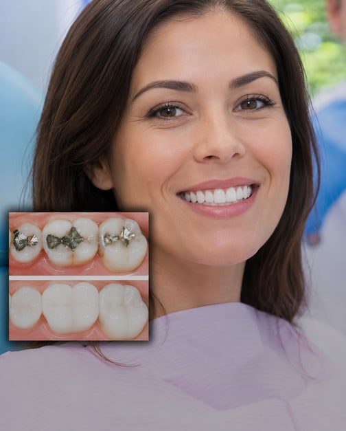 White Fillings