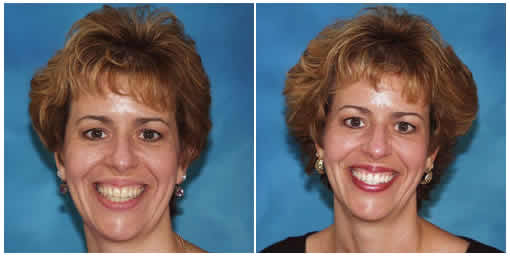 Getting a Stylish New Smile through Invisalign