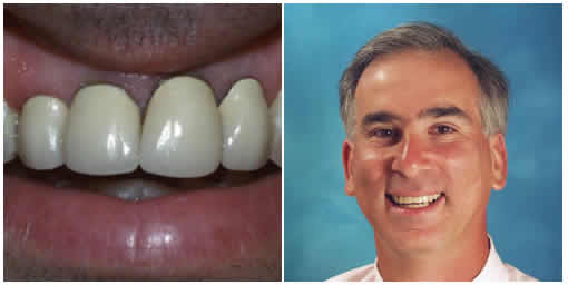 Invisalign: A Hidden Way to Improve Your Smile