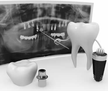 Caring for your Dental Veneers