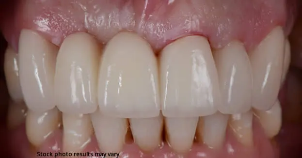 How a Dental Crown or Bridge Can Improve Your Smile