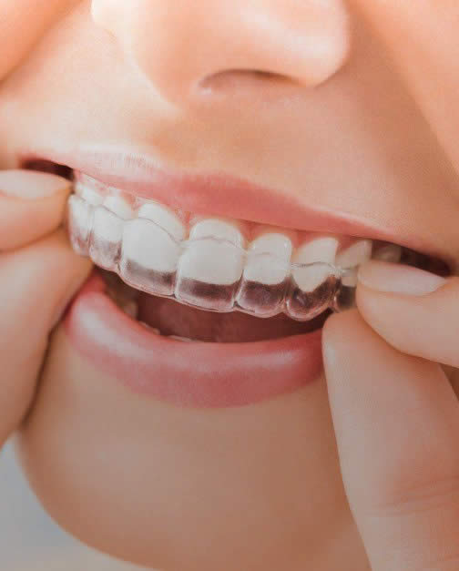 Invisalign and Children - A Good Fit?