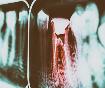 Signs You May Need Root Canal Treatment